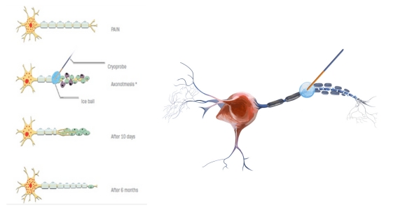 https://gamida.fr/wp-content/uploads/2024/04/Ilustration_cryoanalgesie_578x300.jpg